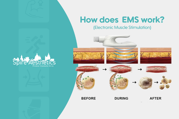 EMS treatment for post pregnancy weight loss treatment Uckfield