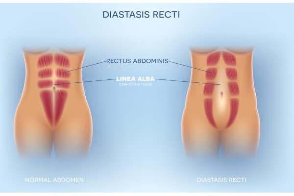What Non-Surgical Options Are Available for Diastasis Recti Uckfield?