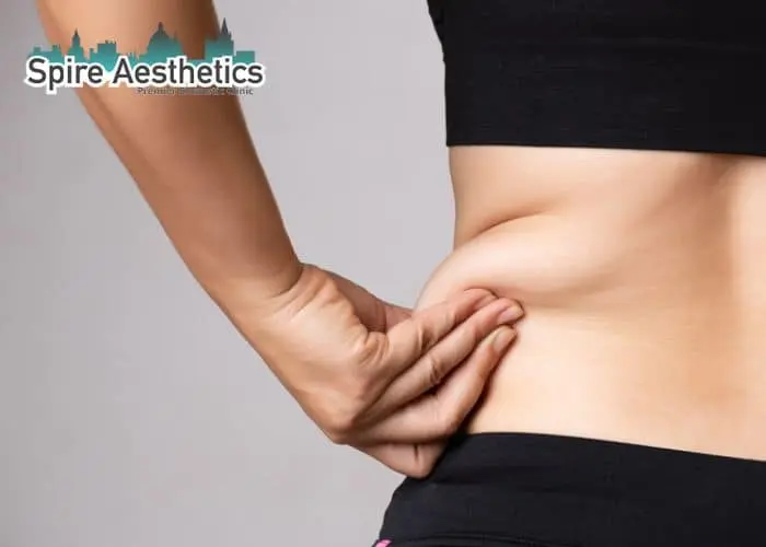 Image of woman pinching fat on their hips Uckfield. Fat Freezing treatment