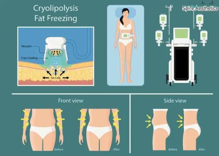 Fat freezing treatment Uckfield benefits for competitions to remove stubborn fat deposits.