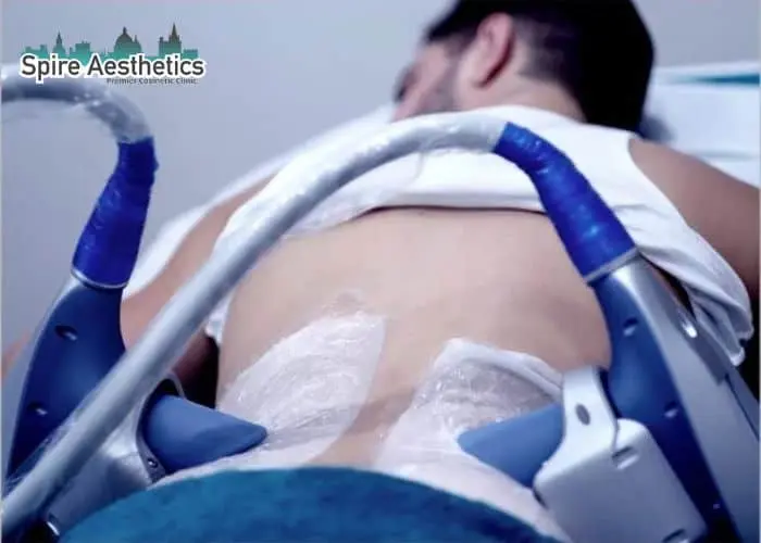 Man having fat freezing treatment done on love handles before a competitions Uckfield to create a sculpted look.