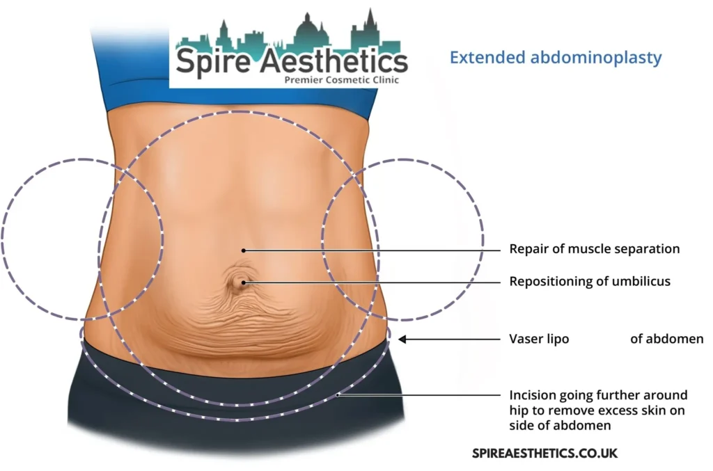 Understanding Loose Skin After Gastric Band Uckfield Surgery and HIFU Treatment