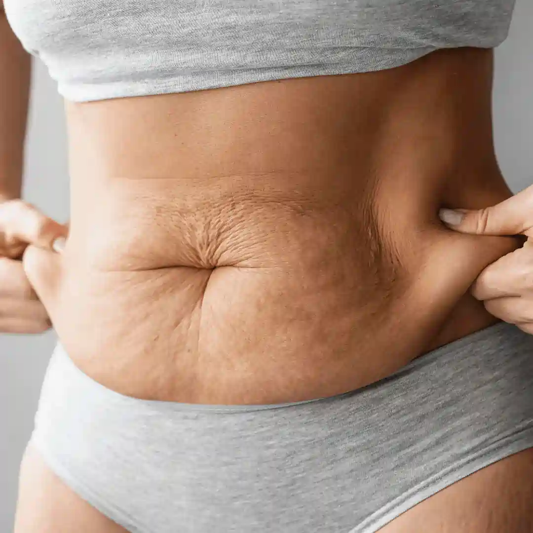 Is It Normal to Have Loose Skin After Pregnancy Uckfield?